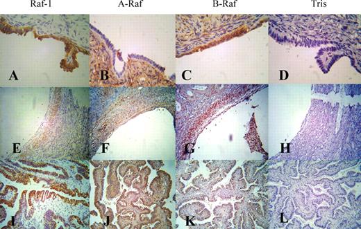  Immunohistological expression of Raf-1, A-Raf and B-Raf in normal ovary and ovarian cancers. Examples of immunoreactivity are illustrated for normal ovarian surface epithelium ( A–D ), granulosa cells of a developing follicle ( E–H ) and an ovarian cancer ( I–L ). Sections were stained by an indirect immunoperoxidase method with antibodies directed against either Raf-1 (A, E and I), A-Raf (B, F and J), B-Raf (C, G and K) or Tris buffer as a negative control (D, H and L). Brown staining indicates immunoreactivity and hematoxylin (blue) was used as the counterstain. All photographs are of the same magnification. 
