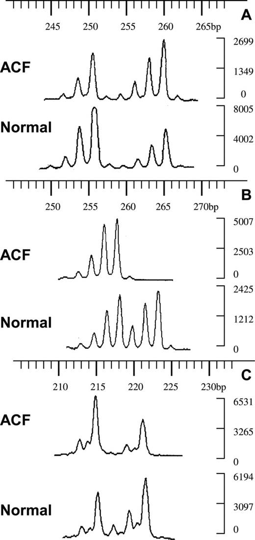  LOH in human ACF at PTPRJ (11p11). Fluorescent electrophoregrams of ACF and normal crypts from three different patients. The sizes of the alleles in base pairs are indicated above; the intensities of the alleles are on the right. ( A ) ACF 4003821A no. 2AD with marker D11S4117, qLOH = 0.5; ( B ) ACF 4006060B1 no. 2A with D11S4117, qLOH > 2; ( C ) ACF 4006518B1 no. 4FG with D11S4183, qLOH = 2.2. 