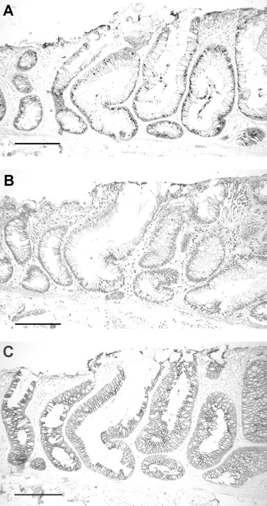  Paraffin-embedded sections of ACF 4006107C2 no. 3A. ( A ) Immunohistochemical demonstration of Apc expression in the cytoplasm of the ACF (large crypts to the right) and in two adjacent normal crypts (left); ( B ) nearby section stained with H&E shows the ACF (large crypts to the right with yellow ink above) with atypia but no dysplasia; ( C ) immunohistochemical demonstration of beta-catenin expression in the membranes of the same ACF and adjacent normal crypts; bar = 200 µm. 
