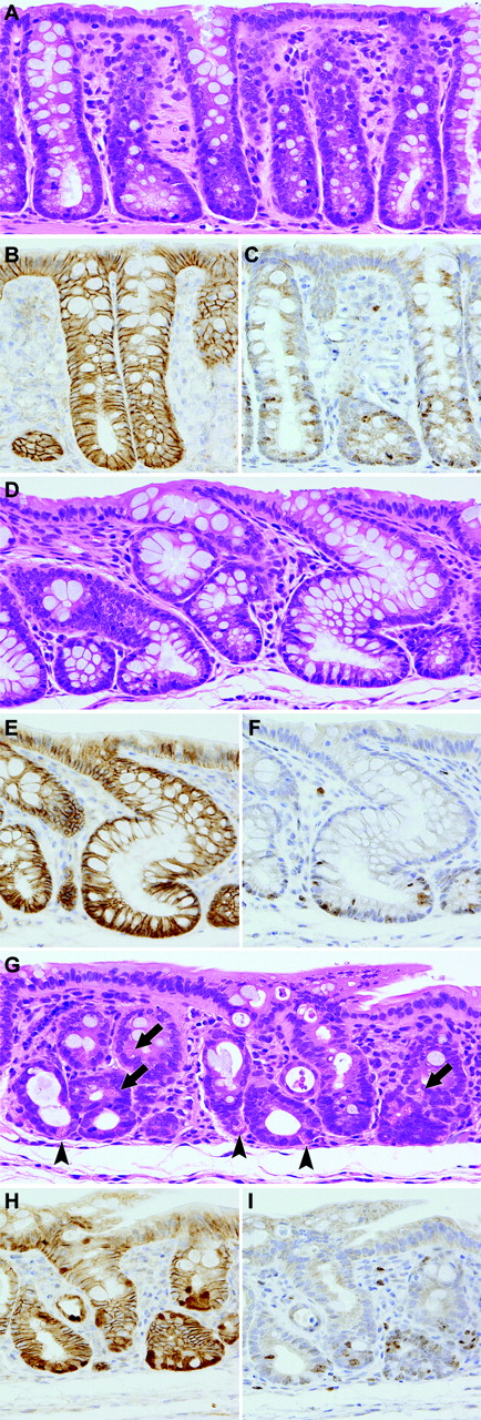  Colorectal mucosal lesions at week 4–6 in routinely longitudinally embedded sections after DSS treatment following DMH initiation. ( A ) Normal mucosa of a non-treated control rat. Hematoxylin and eosin. Original magnification, ×180. ( B ) A serial section of ( A ). Note immunoreactivity of β-catenin in the epithelial cells. β-catenin—immunohistochemistry. ( C ) A serial section of ( A ). Note Ki-67-positive cells in the lower crypt zone. Ki-67—immunohistochemistry. ( D ) Regenerative mucosa showing distortion and/or dilatation of crypts without distinct cellular atypia. Hematoxylin and eosin. Original magnification, ×180. ( E ) A serial section of ( D ). Note immunoreactivity of β-catenin in the epithelial cells. β-catenin—immunohistochemistry. ( F ) A serial section of ( D ). Note Ki-67-positive cells in the lower crypt zone. Ki-67—immunohistochemistry. ( G ) Regenerative mucosa with Paneth cell metaplasia, characterized by cytoplasmic eosinophilic granules, in the lower crypt zone (arrowheads) and middle zone (arrows). Crypts show distortion and shortening. Hematoxylin and eosin. Original magnification, ×180. ( H ) A serial section of ( G ). Nuclear/cytoplasmic expression of β-catenin in subsets of epithelial cells. β-catenin—immunohistochemistry. ( I ) A serial section of ( G ). Note Ki-67-positive cells in the lower crypt zone and the middle zone. Ki-67—immunohistochemistry. 
