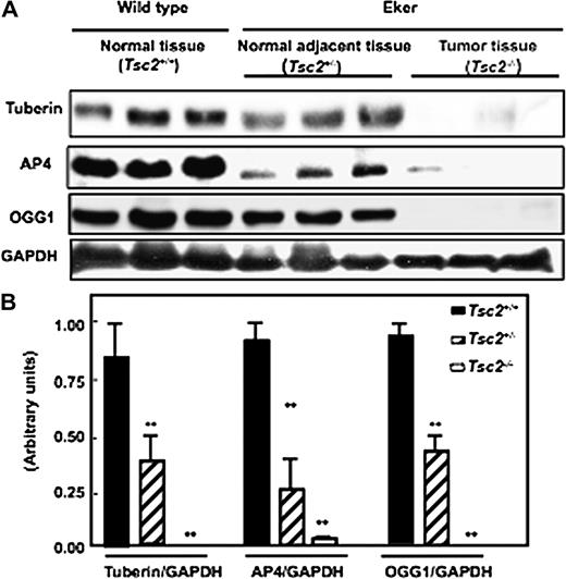  Deficiency of tuberin is associated with the loss of AP4 and OGG1 expression in kidney tumour of Eker rat. ( A ) Immunoblot analysis of tuberin, AP4 and OGG1 expression in kidney cortex of wild-type ( Tsc2+/+ ) (lanes 1–3), normal kidney of Eker rat ( Tsc2+/− ) (lanes 4–6) and tumour kidney ( Tsc2−/− ) (lanes 7–9) of Eker rat. Partial deficiency in tuberin is associated with decreased protein expression of AP4 and OGG1. Complete loss of tuberin expression is associated with abolished AP4 and OGG1 expression in kidney tumour tissues of Eker rat. GAPDH was used as loading control. ( B ) Histograms represent means ± SE of three animals. Significant difference from wild-type animals is indicated by ** P < 0.01. 