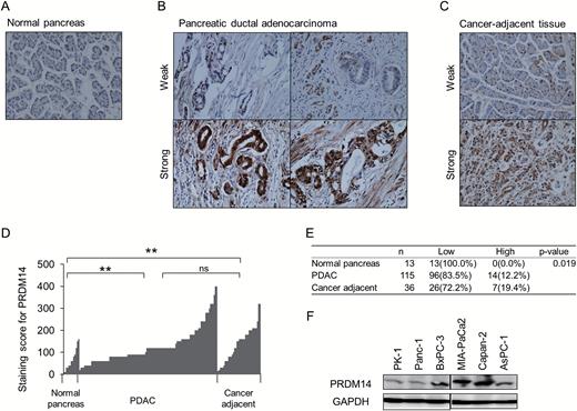 Expression of PRDM14 in pancreatic cancer tissues and cell lines. (A–E) Representative immunohistochemistry images for PRDM14 in 13 normal pancreas (A), 115 pancreatic ductal adenocarcinomas (PDAC) (B) and 36 cancer-adjacent (C) tissues. PDAC and cancer-adjacent tissues are shown with low and high staining intensity. Staining scores for PRDM14 in the tissues are shown in (D and E). **P < 0.002, ns: not significant. (F) Western blotting of PRDM14 protein expression in six pancreatic cancer cell lines. GAPDH was used as a loading control.