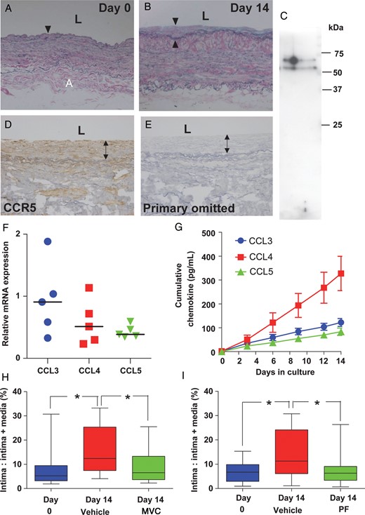 Contribution of CCR5 to intimal hyperplasia in cultured saphenous vein. Cross-section through saphenous vein segment after (A) 0 and (B) 14 days in culture showing the development of a neointima (arrow heads) by Day 14. (C) CCR5 protein detected by western blotting (n = 4, pooled). (D) CCR5 immunoreactivity localized to medial and neointimal layers of cultured vein with staining absent (E) when the primary antibody was omitted. (F) CCL3, CCL4, and CCL5 mRNA (n = 5) were detected in cultured vein and in culture medium (G) during culture (n = 7–8). Co-culture with CCR5 antagonists (H) maraviroc (MVC, n = 10) and (I) PF-232796 (PF, n = 9) inhibited the development of intimal thickening (P < 0.05, Friedman test followed by Dunn's multiple comparison test). Values are median (range).