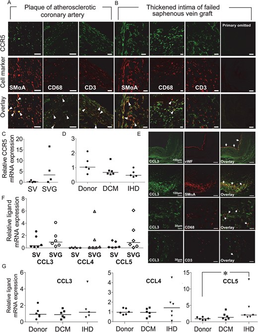 CCR5 receptor protein expression in (A) coronary atherosclerotic plaque and (B) thickened intima of failed saphenous vein graft. Co-localization (overlay: yellow/orange, arrow heads) of CCR5 immunoreactivity (green) with SMαA, CD68, and CD3-positive cells (red). Lack of fluorescence on omission of primary antibody shown for the vein graft. Scale bars: 30 μm. Relative levels of CCR5 mRNA in (C) saphenous vein (SV n = 5) and vein graft (SVG n = 4) and (D) donor (n = 5), DCM (n = 6) and ischaemic (IHD n = 5) myocardium. (E) Expression of CCL3 in saphenous vein graft: CCL3 immunoreactivity (green) co-localized in overlay (orange/yellow) with vWF, SMαA, CD68, and rarely CD3-positive cells (red). (F) Expression of CCL3, CCL4, and CCL5 mRNA was comparable in graft (SVG, n = 6) and normal vein (SV, n = 6). (G) In the left ventricle, CCL5 mRNA was significantly increased in IHD compared with donor (*P < 0.05, n = 6).