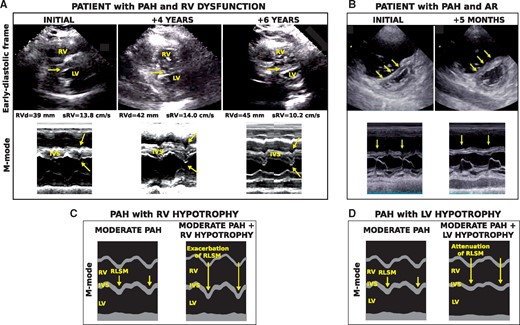 Exacerbation and attenuation of septal motion. An echocardiographic parasternal long-axis view and M-mode are displayed for (A) a patient with PAH (mPAP 59 mmHg) and diagnosis of gradual RV dysfunction at initial hospitalization, 4 years later, and 6 years later, and (B) a patient with PAH (mPAP 38 mmHg), at initial hospitalization and following development of AR 5 months later.77 Simulated M-modes with (C) moderate PAH with RV hypotrophy and (D) moderate PAH with LV hypotrophy are also shown. Increased interventricular relaxation dyssynchrony induced by RV hypotrophy (C) exacerbated septal motion, as observed in (A) following progressive RV dysfunction. In (D), reduced interventricular relaxation dyssynchrony induced by LV hypotrophy attenuated septal motion, as observed in (B) after onset of AR. Abbreviations: Aortic regurgitation (AR), interventricular septum (IVS), mean pulmonary arterial pressure (mPAP), RV basal diameter (RVd), RV pulsed Doppler S wave (sRV). Figure is reproduced from Palau-Caballero et al.56