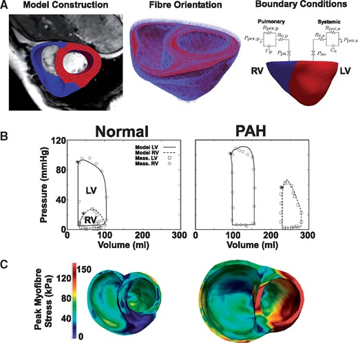 Personalized finite element modelling of pulmonary arterial hypertension. (A) Segmentation and meshing of a biventricular model from CMR. Fibre orientation was assigned using a rule-based method. Windkessel models were used as boundary conditions for the LV and RV. (B) The normal and PAH models reproduced clinically measured LV and RV pressure–volume loops. Note the RV dilation and increased systolic pressure in PAH. (C) Simulated regional distribution of peak myofibre stress within the ventricles. Figure is modified from Xi et al.,16 with permission from the American Society of Mechanical Engineers.