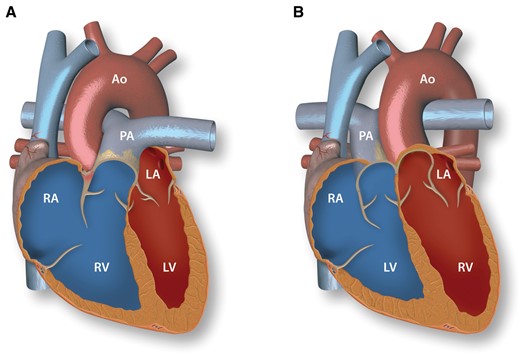 Normal heart anatomy and congenitally corrected transposition of the great arteries. A: Normal heart with concordant atrioventricular and ventriculo-arterial connections. B: Congenitally corrected transposition of the great arteries with atrioventricular and ventriculo-arterial discordance. RV, right ventricle; RA, right atrium; PA, pulmonary artery; LV, left ventricle; LA, left atrium; Ao, aorta.