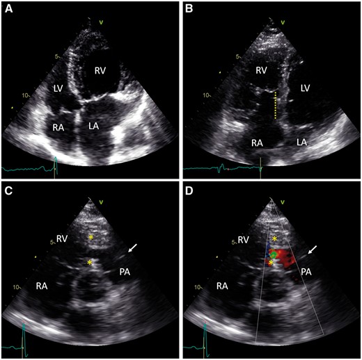 Transthoracic echocardiograms of congenitally malformed adult hearts. A: RV hypertrophy and LA dilation due to tricuspid regurgitation in congenitally corrected transposition of the great arteries. For comparison, no RV hypertrophy is seen in B. B: Apical displacement of the tricuspid leaflet from the tricuspid annulus (dotted line) causes partial RV atrialization in Ebstein’s anomaly. C: Obstructive tissue (*) divides the RV, creating a low-pressure compartment below the pulmonary valve (arrow) in double-chambered right ventricle. D: Doppler colour view shows turbulent flow across the obstruction in double-chambered right ventricle. RV, right ventricle; RA, right atrium; PA, pulmonary artery; LV, left ventricle; LA, left atrium.