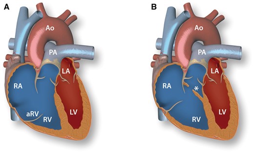 Anatomy of Ebstein’s anomaly and double-chambered right ventricle. A: Ebstein’s anomaly. Lack of delamination of the septal and posterior tricuspid valve leaflets causes apical displacement of the tricuspid annulus with a thin walled atrialized portion of the RV (aRV). B: Double-chambered right ventricle. Subinfundibular tissue (*) crosses the RV cavity and causes obstruction of outflow. RV, right ventricle; RA, right atrium; aRV, atrialized right ventricle; PA, pulmonary artery; LV, left ventricle; LA, left atrium; Ao, aorta.