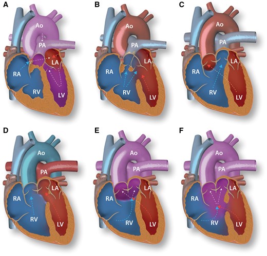 Anatomy of pulmonary atresia, tetralogy of Fallot and double outlet right ventricle. A: RV hypoplasia in pulmonary atresia. Underdevelopment of the RV outflow tract results in pulmonary atresia with a small hypertrophic RV and right-to-left shunting through an interatrial communication as escape route. Blood flows to the pulmonary circulation via the patent arterial duct. B: Tetralogy of Fallot. The aorta overrides the interventricular septum. Due to infundibular pulmonary stenosis there is RV hypertrophy and blood from both ventricles flows to the aorta. C–F: Subtypes of double outlet right ventricle (DORV). Arrows show the predominant direction of blood flow. C: DORV with subaortic VSD. D: DORV with subpulmonary VSD. E: DORV with doubly committed VSD. F: DORV with non-committed VSD. RV, right ventricle; RA, right atrium; PA, pulmonary artery; LV, left ventricle; LA, left atrium; Ao, aorta; VSD, ventricular septal defect.