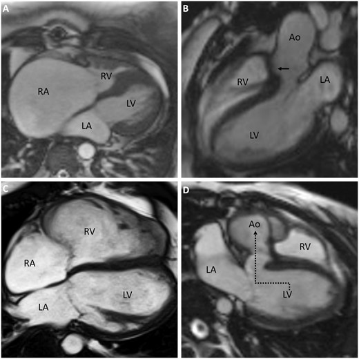 Magnetic resonance images of congenitally malformed adult hearts after surgical repair. A: RA dilation due to limited capacity of the small RV after biventricular repair in hypoplastic RV in context of severe valvar pulmonary stenosis. B: Overriding aorta and closed ventricular septal defect (arrow) in tetralogy of Fallot. C: Right ventricular dilation in tetralogy of Fallot. D: Conduit guiding blood from the LV to the aorta (dotted arrow) in double outlet right ventricle. LV, left ventricle; LA, left atrium; RV, right ventricle; RA, right atrium, Ao, aorta.