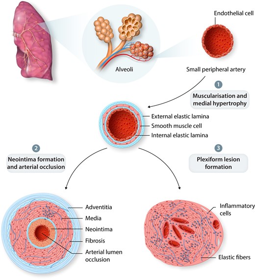 PAH Pathobiology. (1) Remodelling of small peripheral arteries. (2) Arterial lumen occlusion via neomuscularization of the arterial wall and neointimal formation. (3) Loss of normal endothelial function including vessel permeability may result in plexiform lesion formation and inflammatory cell recruitment.