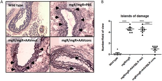 AAV9SLR-mediated hpAP-1 cons hp dONs delivery in aortic grafts from mgR/mgR mice improves elastin architecture. (A) Representative bright-field microscopy images of elastic van Gieson staining of aortic cryosections of the indicated treatment groups, explanted 30 days after surgery. Elastin is stained in black, collagen appears in red and cell nuclei are black-brown. Black arrows indicate ‘islands of damage’, defined as an isolated area of the aortic wall where two adjacent elastic fibres were fragmented with interposed excessive connective tissue.23 (B) Statistical quantification of the number of ‘islands of damage’ in different treatment groups (n = 6, 30 images analysed/group, ***P < 0.001). Scale bar represents 50 μm. Data were analysed using one-way analysis of variance (ANOVA), followed by a post hoc Tukey multiple comparison test.