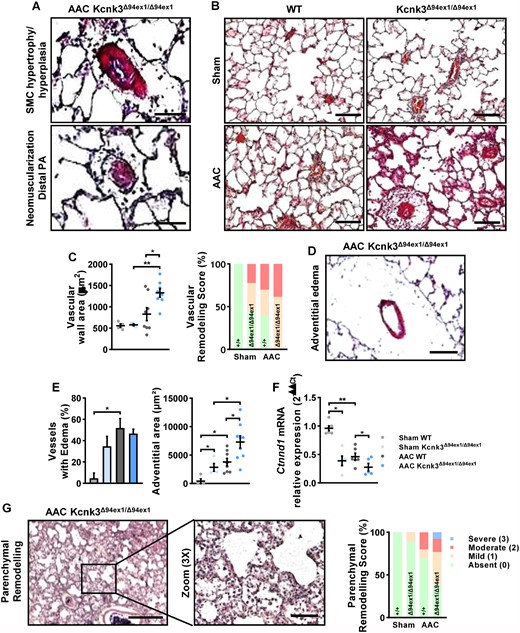Analyses of pulmonary alteration in AAC-Kcnk3Δ94ex1/Δ94ex1 rats. (A) Representative photography of HES staining of lung from AAC-Kcnk3-mutated rats. Upper panel: Smooth muscle cell hypertrophy/hyperplasia in pulmonary arteries, Lower panel: neomuscularization of the small distal and normally not muscularized pulmonary vessels. Scale bars, 50 (upper) and 15 μm (lower). (B) HES staining on lung slice from Sham and AAC WT or Kcnk3Δ94ex1/Δ94ex1 rats. Scale bar, 100 μm. (C) Left panel: quantification of vessel wall area (µm2). Right panel: analysis of the vascular remodelling score in Sham and AAC WT or Kcnk3Δ94ex1/Δ94ex1 rats. Sham-WT (n = 4), Sham-Kcnk3Δ94Ex1/Δ94Ex1 (n = 4), AAC-WT (n = 8), and AAC-Kcnk3Δ94Ex1/Δ94Ex1 rats (n = 8). (D) Illustrative of lung perivascular oedema in AAC-Kcnk3-mutated rats. Scale bar, 50 μm. (E) Left panel, percentage of vessels with large adventitia (which could be measured). Right panel, quantification of adventitia surface area (µm2) in Sham-WT (n = 4), Sham-Kcnk3Δ94Ex1/Δ94Ex1 (n = 4), AAC-WT (n = 8), and AAC-Kcnk3Δ94Ex1/Δ94Ex1 rats (n = 9). (F) Relative mRNA expression (2−ΔΔCt) of Ctnnd1 (encoding p120Catenin) in lung from Sham-WT (n = 6), Sham-Kcnk3Δ94Ex1/Δ94Ex1 (n = 5), AAC-WT (n = 6), and AAC-Kcnk3Δ94Ex1/Δ94Ex1 rats (n = 5). Experiments were normalized by 18S mRNA and analysed using ΔCt values. (G) Left panel, illustrative images of severe lung injury with prominent enlargement of alveolar septa and inflammatory exsudates observed in AAC-Kcnk3-mutated rats. Scale bar, 500 and 100 μm. Right panel, analysis of the parenchym alteration score in Sham-WT (n = 4), Sham-Kcnk3Δ94Ex1/Δ94Ex1 (n = 4), AAC-WT (n = 4), and AAC-Kcnk3Δ94Ex1/Δ94Ex1 rats (n = 4). Data are represented as scatter dot plots, with mean ± SEM. Experiments presented in panels A–B and D–F were analysed using two-way ANOVA followed by Sidak’s post hoc test, and experiments presented in panels C and G were analysed using one-way ANOVA followed by Dunn’s post hoc test after Kruskal–Wallis test. *P < 0.05, **P < 0.01. Vascular wall area, oedema, and adventitial area were not normally distributed and were log-transformed prior to statistical analysis.