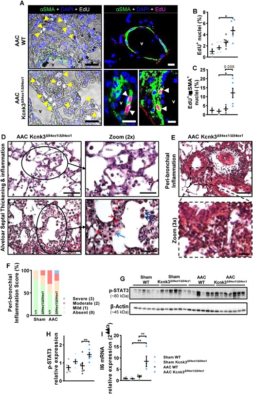 Characterization of pulmonary remodelling in AAC-rats. (A) Immunofluorescent staining of frozen rat lung sections and confocal imaging with Click-iT 5-ethynyl-2′-deoxyuridine (EdU; white or pink nuclei = EdU-positive nuclei = proliferating cells) in combination with α-smooth-muscle actin (α-SMA; in green) in AAC-WT and AAC-Kcnk3-mutated rats. Counterstain was DAPI (blue). EdU positive nuclei are indicated by yellow/white arrows, and vessel lumen is indicated (v). Scale bar, 50 μm (left panels) and 20 μm (right panels). (B) Quantification of the percentage of lung proliferating cells (% of EdU-positive nuclei) in Sham-WT (n = 5), Sham-Kcnk3Δ94Ex1/Δ94Ex1 (n = 6), AAC-WT (n = 6), and AAC-Kcnk3Δ94Ex1/Δ94Ex1 rats (n = 6). (C) Quantification of the proportion of EdU positive + αSMA positive cells in in Sham-WT (n = 3), Sham-Kcnk3Δ94Ex1/Δ94Ex1 (n = 3), AAC-WT (n = 4), and AAC-Kcnk3Δ94Ex1/Δ94Ex1 rats (n = 6). (D) Upper panel, in a group of AAC-kcnk3-mutated rats alveolar wall appeared thickened. The alveolar septa enlargement is characterized by the affluence of inflammatory cells (mostly mononucleated), and at some degree to alveolar oedema. Lower panel, in severe cases the alveolar septa enlargement is hypercellular, with many inflammatory cells (red arrow), macrophages (blue arrow) and interstitial oedema (black star). Endoalveolar macrophages are also visible (dark blue arrows). No fibrin deposits nor alveolar necrosis are observed. Scale bars, 100 and 50 (zoom) μm. (E) Severe peri-bronchial/perivascular inflammation, extending in peri-bronchiolar alveoli. Scale bars, 100 and 25 (zoom) μm. (F) Analysis of the peri-bronchiolar inflammation score in Sham-WT (n = 4), Sham-Kcnk3Δ94Ex1/Δ94Ex1 (n = 4), AAC-WT (n = 4), and AAC-Kcnk3Δ94Ex1/Δ94Ex1 rats (n = 4). (G) Western blot images of the phosphorylation of STAT3 protein in lung lysates. (H) Quantification of the phosphorylation of STAT3 protein in lung from Sham-WT (n = 6), Sham-Kcnk3Δ94Ex1/Δ94Ex1 (n = 6), AAC-WT (n = 6), and AAC-Kcnk3Δ94Ex1/Δ94Ex1 (n = 7) rats (see the complete unedited gel in see Supplementary material online, Figure S8). (I) Relative mRNA expression (2−ΔΔCt) of Il-6 in lung from Sham-WT (n = 6), Sham-Kcnk3Δ94Ex1/Δ94Ex1 (n = 6), AAC-WT (n = 4), and AAC-Kcnk3Δ94Ex1/Δ94Ex1 rats (n = 4). Experiments were normalized by 18S mRNA and analysed using ΔCt values. Data are represented as scatter dot plots, with mean ± SEM. Experiments presented in panels A–B, D–E, G–H, and I were analysed using two-way ANOVA followed by Sidak’s post hoc test, and experiments presented in panels C and F were analysed using one-way ANOVA followed by Dunn’s post hoc test after Kruskal–Wallis test,***P < 0.001. *P < 0.05, **P < 0.01, and ***P < 0.001. Edu+ and Edu+/αSMA+ and Stat3 phosphorylation were not normally distributed, and were log-transformed prior to statistical analysis.
