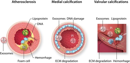 Calcifying cardiovascular pathologies. Cardiovascular mineralization occurs as atherosclerosis, medial calcification, and valve calcifications. Atherosclerotic plaque calcification is characterized by lipoprotein infiltration, foam cell formation and exosome release from smooth muscle cells, as well as intraplaque haemorrhage, cell death, and DNA retention. In contrast, medial calcification develops in the absence of inflammatory cells and involves degradation of the internal elastic lamina in the extracellular matrix (ECM), DNA damage, exosome release, and calcium phosphate precipitation from circulating inorganic phosphate (Pi). Valve calcification is highly dependent on biomechanical and haemodynamic factors, and has the characteristics of atherosclerotic and medial calcification, with a strong inflammatory component. The initial localizations of calcifications are indicated in blue.