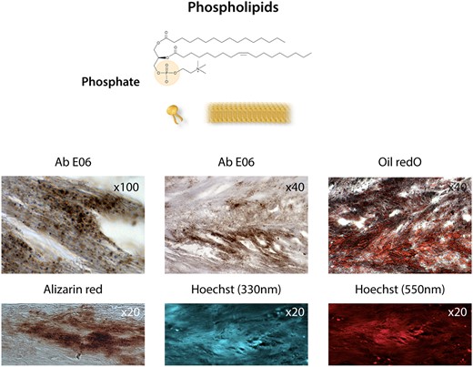Membranous phospholipids. Phosphate at the polar head of phospholipids in cell membranes, i.e. the plasma membrane, mitochondrial membranes, and the nuclear envelope, as well as in exosomes. Bottom photo panel: The co-localization of oxidized phospholipids stained with the antibody Ab E06 (Sigma) and lipids (oil red O staining), calcification (Alizarin red staining after EDTA chelation of Ca++), Hoechst staining at 330 nm (UV), and at 550 nm (red) indicates the presence of phosphates (see text76,77) in a section of an aortic valve leaflet in the initial calcification step.