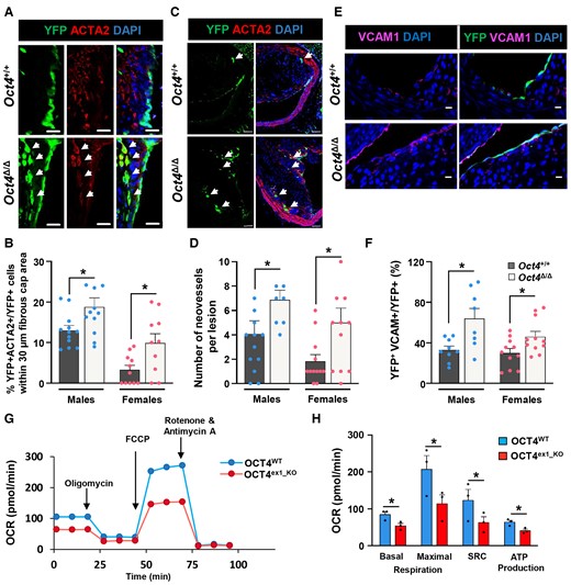 Loss of OCT4 in EC results in increased EndoMT, neovascularization, and the number of VCAM1+ cells in plaques and decreased mitochondrial respiration in vitro. (A and C) Representative immunostaining on serially sectioned BCAs collected from Oct4+/+ or Oct4Δ/Δ mice fed WD for 18 weeks; fibrous cap area (A) or lesion area (C). (A) White arrows indicating YFP+ACTA2+ EC undergoing EndoMT. Scale bar = 20 µm. (B) Quantification of the percentage of YFP+ACTA2+ cells within the total YFP+DAPI+ cell population in the 30 µm protective fibrous cap area of the male and female lesions. Data were analysed by unpaired t-test (males) or non-parametric Mann–Whitney test (females); *P < 0.05 (n = 12 males; 12 females) vs. Oct4Δ/Δ (n = 12 males; 11 females) mice. (C) White arrows indicating capillary-like YFP+ neovessels. Scale bar = 50 µm. (D) Quantification of the number of YFP+ intraplaque capillary-like neovessels. Values = mean ± S.E.M.; data were analysed by non-parametric Mann–Whitney test; *P < 0.05 Oct4Δ/Δ (n = 9 males; 12 females) vs. Oct4+/+ (n = 9 males; 11 females) mice. (E) Representative immunostaining serially sectioned BCAs collected from Oct4+/+ or Oct4Δ/Δ male fed WD for 10 weeks. Scale bar = 10 µm. (F) Quantification of the percentage of YFP+VCAM1 + DAPI+ cells within the total YFP+ cell population at the luminal surface of the male and female vessels. Values = mean ± S.E.M.; *P < 0.05 by unpaired t-test (females) or unpaired t-test with Welch’s correction (males). Oct4+/+ (n = 8 males; 11 females) and Oct4+/+ (n = 8 males; 11 females) mice after 10 weeks of WD feeding. (G) Graphical representation of the Seahorse XF24 Cell Mito Stress Test assays measuring the oxygen consumption rates (OCR) in OCT4WT and OCT4ex1_KO HUVECs with arrows indicating treatments with specific stressors: oligomycin, carbonyl cyanite-4 (trifluoromethoxy) phenylhydrazone (FCCP), and Rotenone/Antimycin A. (H) Quantification of OCR in OCT4WT and OCT4ex1_KO HUVECs revealed a significant difference in basal mitochondrial respiration, maximum respiration, spare respiratory capacity (SRC), and ATP production. Values = mean ± S.E.M.; *P < 0.05 by two-way ANOVA, n = 3 independent experiments.