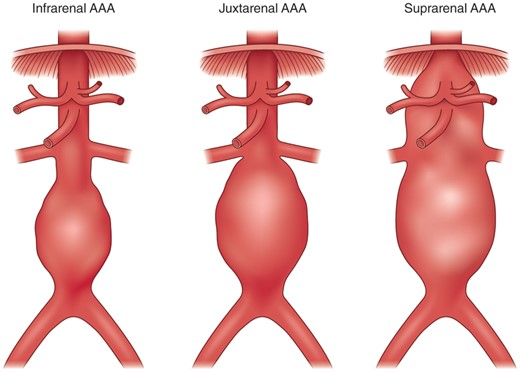 Classification of abdominal aortic aneurysms. Infrarenal aneurysms have a proximal aortic neck that provides an adequate landing zone for the endovascular device; in juxtarenal aneurysms the aneurysm involves the infrarenal abdominal aorta adjacent to or including the lower margin of renal artery origins; suprarenal AAAs and thoraco-abdominal aneurysms extend above the orifice of renal arteries.