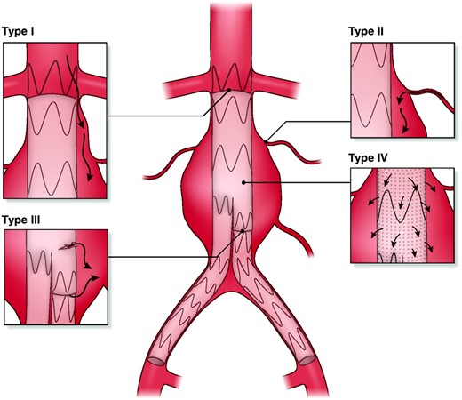 The types of endoleaks after endovascular aortic repair: Type I, leak at the proximal or distal landing of the graft; Type II, leak via branches (e.g. lumbar artery) into the aneurysm sac; Type III, modular defect or tearing of the graft material; Type IV, graft porosity.