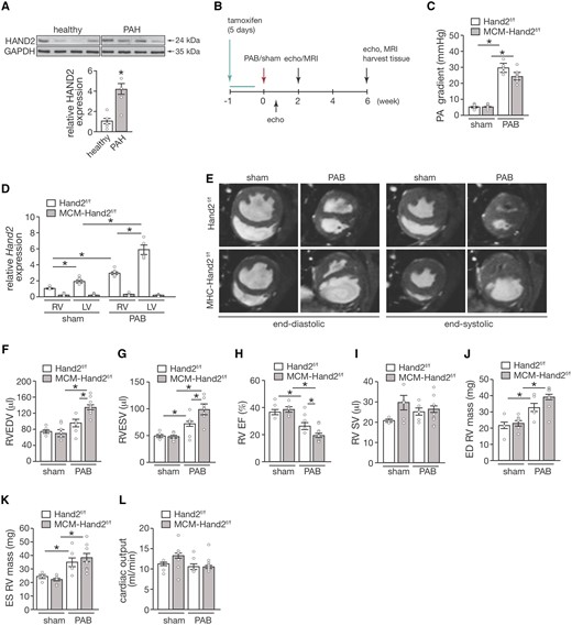 Cardiac-specific depletion of Hand2 sensitizes the RV to pressure overload. (A) Western blot analysis of HAND2 and GAPDH as loading control in human heart tissue from healthy controls and pulmonary arterial hypertension patients. (B) Design of the in vivo study; (C) assessment of pulmonary artery pressure gradient in control (Hand2F/F) and knockout (MCM-Hand2F/F) mice 5 days after either sham or PAB surgery; (D) quantitative real-time PCR analysis of Hand2 expression in RV tissue from Hand2F/F and MCM-Hand2F/F animals either after sham or PAB surgery; (E) representative images of short-axis plan in end-diastole and end-systole hearts obtained by cardiac resonance image from Hand2F/F and MCM-Hand2F/F animals either after sham or PAB surgery Cardiac function was assessed in hearts from Hand2F/F and MCM-Hand2F/F animals either after sham or PAB surgery, and followed by quantitative analysis: (F) RV EDVs and (G) RV ESVs; (H) RV EF; (I) RV SV; (J) RV end-diastolic mass; (K) RV end-systolic mass; and (L) CO. Data are from 5–10 animals per group. Statistical analysis using one-way ANOVA with Tukey’s multiple comparisons test. ∗P<0.05 between indicated groups (error bars are SEM).