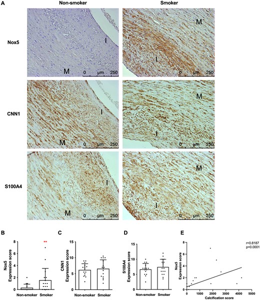 Smoking and calcification are associated with increased carotid artery Nox5 expression. (A) Immunohistochemical analysis of Nox5, CNN, and S100A4 expression in carotid artery samples from human donors. I and M indicate intima and media, respectively. Scale bars are 250 µm. Figure shows representative images from 32 carotid artery samples that were stained (15 smokers, 15 non-smokers). (B–D) Quantification of protein expression scores. Statistical significance was tested with Mann–Whitney U-test. Dots denote individual data points. Graphs (B–D) show n ≥ 15 plaques for smokers, n ≥ 15 plaques for non-smokers. (E) Nox5 expression positively correlates with calcification (P < 0.001, r = 0.8187 and P < 0.0001, r = 0.794, when outliers are removed). Nox5 expression scores were plotted against µCT total calcification scores for each patient. Graph shows individual data points (both smokers and non-smokers). Linear regression was plotted, and a two-tailed Pearson correlation test was carried out. Graph shows n = 14 plaques.