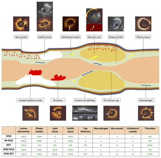 Advantages and limitations of the clinically available intravascular imaging modalities for assessing vessel wall pathology. The table at the bottom of the figure provides a quantification of the efficacy of each modality in detecting different tissue types using histology as the reference standard. The symbol (−) indicates that the modality is unable to detect the specific characteristic. Conversely, the symbols (+), (++), and (+++) indicate weak, moderate, and excellent ability of the modality to detect a plaque characteristic, respectively. White arrows indicate neo-vessels, cholesterol crystal, erupted calcified nodule, thin fibrous cap and macrophages infiltration in cross-sectional OCT images. Asterisks indicate calcific tissue on IVUS (upper panel) and OCT (lower panel) and evidence of intraluminal thrombus on OCT. A red arc defines the lipid necrotic core in NIRS-IVUS image. The superimposed light blue colour indicates plaque burden and positive remodelling on IVUS, while the ivory colour defines fibrous tissue on OCT. IVUS, intravascular ultrasound; NIRS, near-infrared spectroscopy; OCT, optical coherence tomography; RF, radiofrequency.