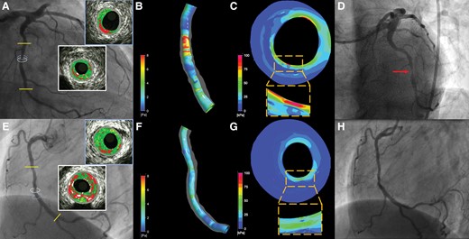 Case examples highlighting the prognostic value of the local hemodynamic forces in predicting events. Panel (A) illustrates the angiographic image of a lesion located in the mid left circumflex that caused an event at 13-month follow-up (D). VH-IVUS imaging showed a moderate lesion with a minimum lumen area of 2.94 mm2 (indicated with a white circle on angiography, the corresponding VH-IVUS cross-section is shown in the white inset), a plaque burden of 70.5% and a TCFA phenotype. Blood flow simulation analysis demonstrated high wall shear stress (WSS) at the throat of the lesion with the maximum predominant WSS estimated at 6.94 Pa (B), while plaque structural stress (PSS) analysis also showed increased plaque stress (C) estimated at 123 kPa (maximum PSS location on coronary angiography is indicated with a light blue circle, the corresponding VH-IVUS cross-section is shown in the light blue inset). Panel (E) portrays the angiographic image of a moderate lesion located in the right coronary artery that remained quiescent at 13-month follow-up (H). VH-IVUS imaging showed a plaque with a TCFA phenotype, minimum lumen area of 3.75 mm2 (its location in coronary angiography is shown with a white circle and the VH-IVUS image in the white inset) and similar plaque burden (78.6%) compared to the previous lesion. However, in this occasion, the maximum predominant WSS was normal (3.73 Pa, F), while PSS (the location in angiography is shown with a light blue circle and the corresponding VH-IVUS frame in the light blue inset) was lower (71 kPa, G) suggesting an athero-protective hemodynamic environment that inhibited atherosclerotic disease progression.