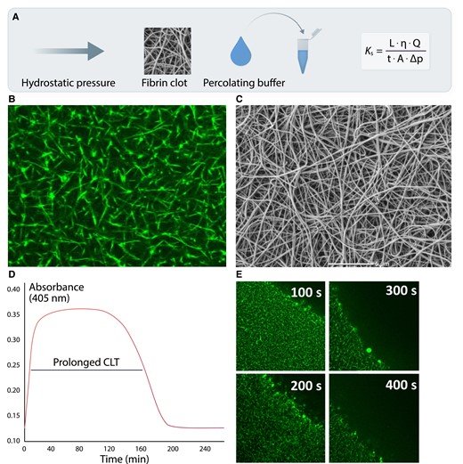 Common measures describing fibrin clot structure and function. A key measure reflecting an average pore size within a fibrin network, based on hydraulic conductivity is clot permeability or permeation (Ks; panel A). Q denotes the flow rate; L, the length of a fibrin gel; µ, the viscosity of liquid (in poise); A, the cross-sectional area (in cm2), Δp, a differential pressure (in dyne/cm2), and t the percolating time. Reduced Ks as a typical feature of the prothrombotic fibrin clot phenotype is usually associated with lower fibrin fibre diameter, lower pore size, and increased number of fibrin branch points visualized using confocal (panel B) and scanning electron microscopy (panel C). Faster fibrinogen polymerization results in the formation of a denser fibrin network (higher clot turbidity), which is relatively resistant to fibrinolysis as reflected by prolonged clot lysis time (CLT; panel D), or real-time clot lysis assessed using confocal microscopy (panel E).