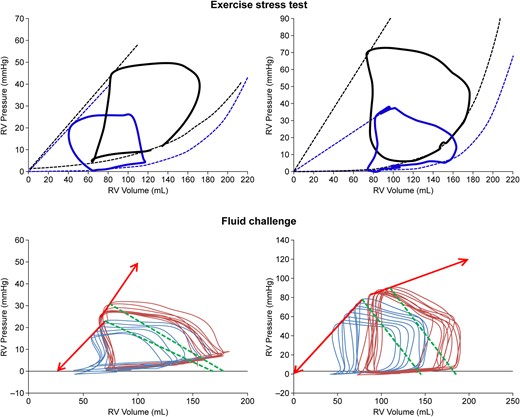 Upper range: single beat pressure–volume (PV) loops of the RV at rest (blue) and during exercise (black). Lower range: multiple beat PV loops before (blue) and after (red) a fluid challenge. Exercise was associated with either an unchanged Ees with an increase in ESV and EDV (left) or an increase in Ees and unchanged ESV with moderate increase in EDV (right). Exercise revealed a preserved contractile reserve to prevent increased RV volumes. Fluid loading was associated either with an increase in Ees with an increase in EDV more than ESV (left) or a decrease in Ees with increases in both ESV and EDV (right). Fluid loading revealed exhausted contractile reserve and pending RV failure.
