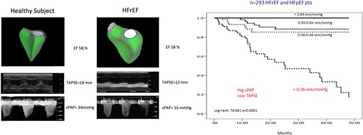 Measurements of RVEF by 3D echocardiography (upper panels, left), M-mode TAPSE (middle panels), and maximum velocity of tricuspid regurgitation to estimate sPAP (lower panels) are shown in a healthy subject and in a subject with HFrEF. The prognostic relevance of the TAPSE/sPAP ratio in a cohort of patients with either HFrEF or HF with preserved EF reduced or preserved LV EF is also shown (after reference,110 with permission).