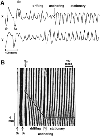 Anchoring of a drifting spiral wave. (A) Electrocardiographic recordings showing that premature stimulation (S2) produced polymorphic arrhythmic activity followed by a transition to sustained monomorphic tachycardia. (B) Time–space plot of activation spread obtained from video-imaging of the fluorescence of a voltage-sensitive dye. In these plots activity from the whole image is projected onto a single direction (vertical axis) and displayed as a function of time. White bands show planar wave propagation while the branching of bands indicates the presence of a spiral wave induced by S2 stimulation. The spiral wave drifted during the first 7 cycles and became stationary thereafter. Reproduced with permission [79].