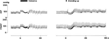 Typical intra-arterial and finger arterial pressure registrations during the Valsalva manoeuvre (left) and standing-up (right). Pressure changes in intraarterial pressure are followed closely but finger pulse pressures are systematically greater in this subject. (Figure is a composition of original tracings published elsewhere [25, 27]).