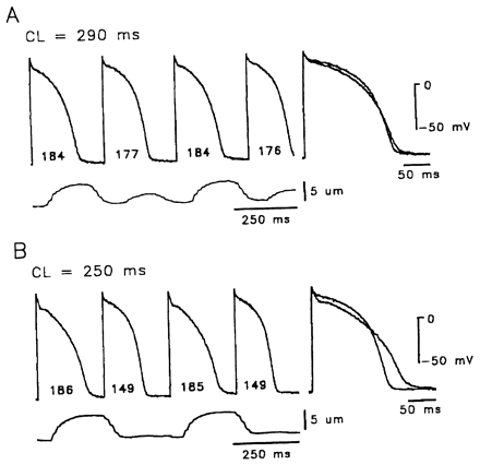 Tracings showing effect of shorter cycle lengths (CL) on mechanoelectrical alternans in a feline ventricular myocytes. (A) Concordant electrical (upper trace) and mechanical (cell length change; lower trace) alternans of a cell stimulated at a cycle length of 290 ms. Beats with longer action potential duration (APDs) were associated with larger contraction. Numbers under each action potential are APD in ms at 90% repolarization. Right inset shows two sequential action potentials superimposed. (B) Concordant electrical (upper trace) and mechanical (lower trace) alternans of the same cell at a shorter cycle length (250 ms). Reproduced from: Rubenstein DS, Lipsius SL. Premature beats elicit a phase reversal of mechanoelectrical alternans in cat ventricular myocytes. A possible mechanism for reentrant arrhythmias. Circulation 1995:91;201–214. Reprinted with permission.