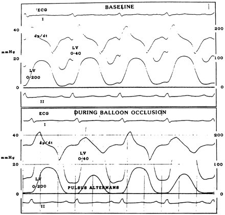 Left ventricular pressure hemodynamics before and during pulsus alternans induced by IVC balloon occlusion in a patient with nonischemic cardiomyopathy. The dramatic alteration in LV diastolic pressures are noted in association with a slight increase in the heart rate. Despite significant systolic pulsus alternans, there is little difference in the end-diastolic pressures between weak and stoning betas. In this patient both peak positive dp/dt and peak negative dp/dt alternans is present. Reproduced from: Bashore TM, Walker S, Van Fossen D, Shaffer PB, Fontana ME, Unverferth DV. Pulsus alternans induced by inferior vena caval occlusion in man. Cathet Cardiovasc Diagn 1988;14:24–32. Reprinted by permission of Wiley–Liss, a subsidiary of Wiley.