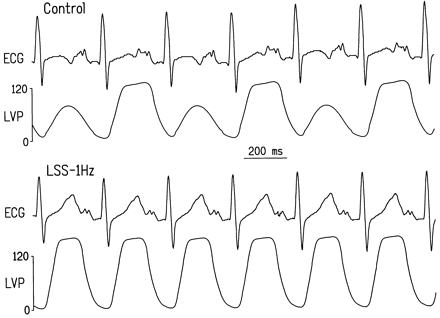 Electrical and mechanical alternans induced by rapid atrial pacing in the intact canine heart. The records show a lead II ECG and left ventricular pressure (LVP, mmHg). The top two traces were obtained during control conditions at a pacing cycle length of 300 ms. The bottom two recordings were obtained at the same pacing cycle length in the presence of left stellate stimulation (LSS) at a frequency of 1 Hz. Reproduced from: Euler DE, Guo H, Olshansky B. Sympathetic influences on electrical and mechanical alternans in the canine heart. Cardiovasc Res 1996;32:854–860.