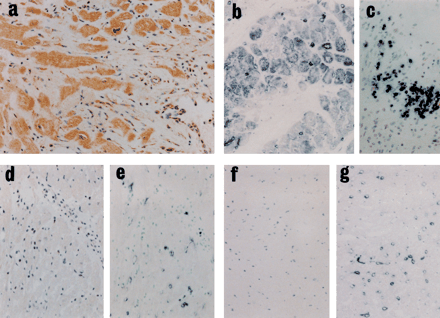 Immunohistochemical study for iNOS and TNF-α. (a) In tissue specimens from rats in Group A, lymphocytes, macrophages, neutrophils, giant cells, myocytes, vascular endothelial cells and vascular smooth muscle cells in inflammatory lesions stained positive for iNOS (original magnification, ×200). (d) In tissue specimens from rats in Group-0, most of the focally infiltrating inflammatory cells and cardiomyocytes were iNOS-negative (original magnification, ×100). (f) Group C exhibited no positive staining for iNOS (original magnification, ×100). In tissue specimens from rats in Group A, myocytes (b, original magnification, ×200) as well as infiltrating inflammatory cells (i.e. lymphocytes, macrophages and neutrophils) (c, original magnification, ×400) and endothelial cells in inflammatory lesions stained positive for TNF-α. (e) In tissue specimens from cats in Group B, most of the focally infiltrating inflammatory cells and cardiac muscle cells were TNF-α-negative (original magnification, ×100). (g) In Group C, only endothelial cells exhibited positive staining for TNF-α (original magnification, ×100).