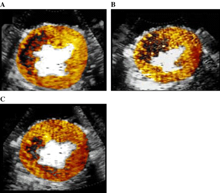 Myocardial contrast echocardiography-derived ‘no reflow’ zones for images from dogs receiving A) saline (Group 1), B) MK-383 (Group 2), and CP-4715 (Group 3).