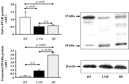 Left panels: Histograms showing the expression of native (53 kDa) and truncated (30 kDa) PPARα protein isoforms in the myocardium of HT, LVH and HF groups. Right panel: Representative Western blots obtained in one subject from each group. ADU, arbitrary densitometric units.