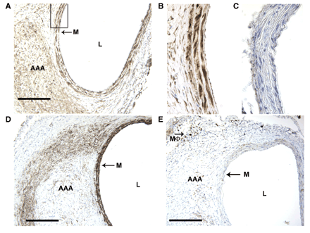 Immunohistochemical analysis of COX-2 expressing cell types in AAAs. COX-2 expression in abdominal aorta from COX-2+/+ at (A) ×100 magnification with boxed region shown in (B) at ×300 magnification and (C) COX-2−/− mice. (D) Smooth muscle α-actin expression at ×100 magnification. (E) Macrophage marker (Mac-3) expression at ×100 magnification. Brown staining indicates COX-2, actin, or Mac-3 expression and sections are counterstained with hematoxylin (blue). Scale bar 200 μm. Lumen (L), media (M), abdominal aortic aneurysm (AAA), and macrophage (Mϕ).