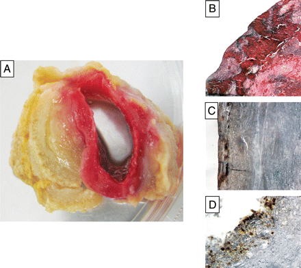 Biological features of the intraluminal thrombus (ILT). (A) Macroscopic view showing the red, most recent, luminal layer of the ILT and the abluminal proteolysed layer. (B) Microscopic aspect of the luminal layer including trapped red blood cells and a large area of nucleated, cell-rich fibrin (haematoxylin and eosin, ×4). (C) Immunostaining of platelet glycoprotein Ib on the luminal ILT surface (×4). (D) Immunostaining of neutrophils (CD66b) on the luminal surface (×4).