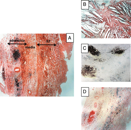 Biological features of the outer media and adventitia in human aneurysm of the abdominal aorta (AAA). (A) General view of the outer part of an AAA showing the inner ILT, the remaining media (difficult to delimit exactly in the absence of elastic laminae), and the highly vascularized outer adventitia, containing well-organized inflammatory granuloma (haematoxylin and eosin, ×4). (B) Cholesterol crystal clefts in the outer media (haematoxylin and eosin, ×10). (C) Granuloma can be easily identified as adventitial tertiary lymphoid organs by their high density of B lymphocytes (CD 20 immunostaining, ×4). (D) Presence of a high density of phagocytosed haemosiderin mainly in the outer part of the media (Perls blue staining, ×4), providing evidence of convection towards the adventitia of haem released by the ILT.
