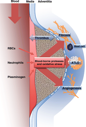 Schematic representation of the impact of the blood–ILT interface on medial degradation and the adventitial inflammatory, angiogenic and fibrotic responses in human AAA. Abbreviations: ATLO, adventitial tertiary lymphoid organ; and RBCs, red blood cells.