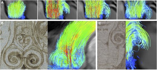 Flow vortices in the aortic root. (A) Sequential images of the flow in the aortic root using velocity encoded (4D) MRI showing laminar flow early in systole with laterally placed vortices in late systole. (B and C) Comparison of the drawings of flow vortices visualized by Leonardo da Vinci (1513) (left) with the corresponding in vivo 4D-MRI (2013) (right), confirming Leonardo’s predictions.