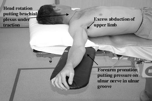 Poor positioning of upper limb leading to nerve traction and compression.