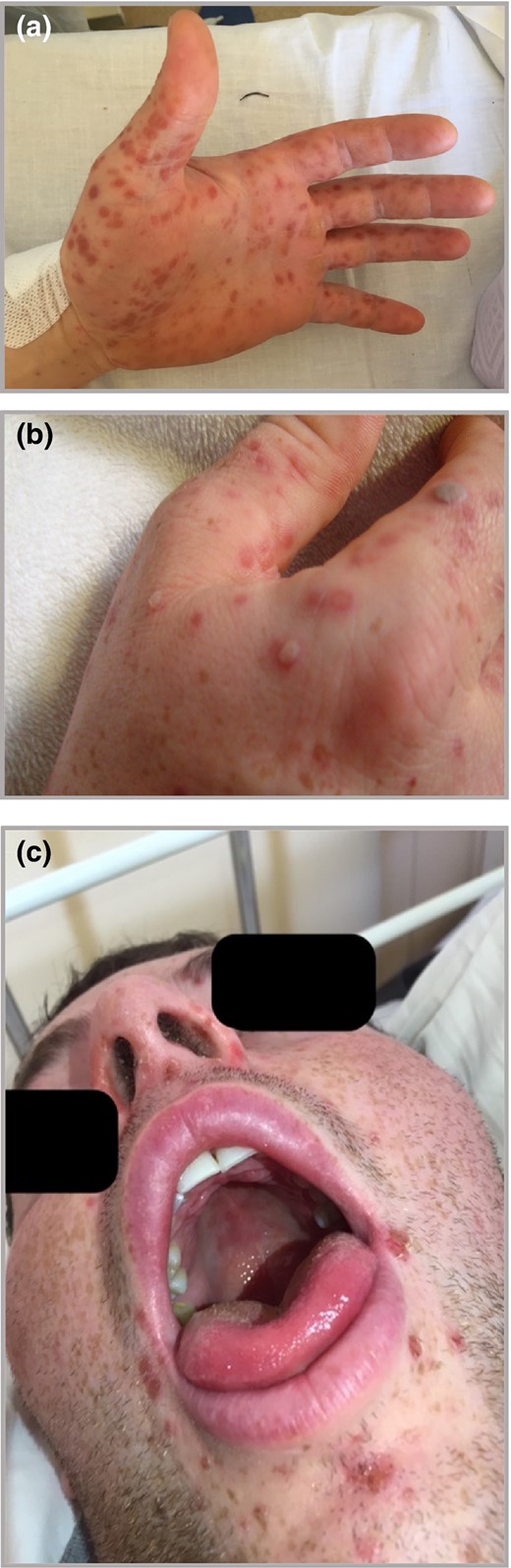 acral papulovesicular eruption | Clinical and Experimental Dermatology ...
