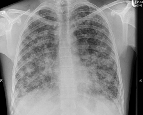 Chest radiograph of a 15-year-old boy with autosomal recessive chronic granulomatous disease, showing bilateral dense infiltrates because of Aspergillus fumigatus and Absidia corymbifera pneumonitis (courtesy of the Paediatric Immunology Unit, Newcastle General Hospital).