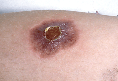 Pyoderma because of Pseudomonas auruginosa infection in a boy with X-linked agammaglobulinaemia (courtesy of the Paediatric Immunology Unit, Newcastle General Hospital).