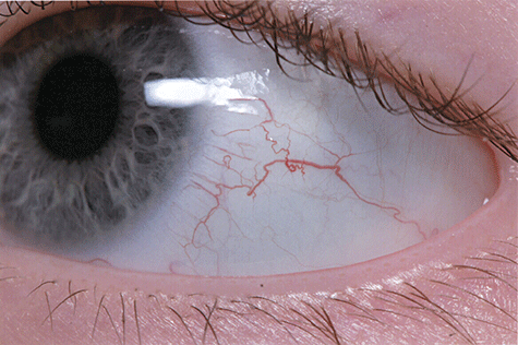 Bulbar telangiectasia on the conjunctivae of a girl with ataxia telangiectasia (courtesy of the Paediatric Immunology Unit, Newcastle General Hospital).