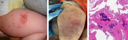 Vaccine-acquired varicella (VZV) infection: histopathology and progression of skin lesions. (a) Initial presentation: clustered vesicular lesions at VZV vaccine injection site. (b) Progression of VZV infection 2·5 weeks later: clustered lesions at VZV vaccine injection site. (c) Multi-nucleated giant cells from VZV skin lesion biopsy: demonstrated on histopathology [photomicrograph provided by National Center for Disease Control and Prevention (CDC)].